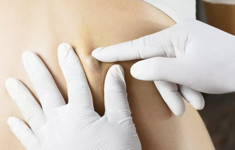 sebaceous cyst