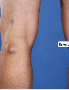 popliteal cyst